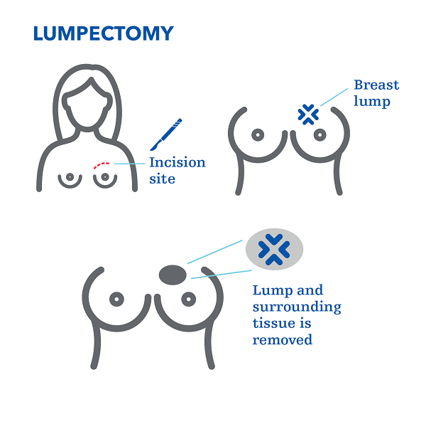 lumpectomy