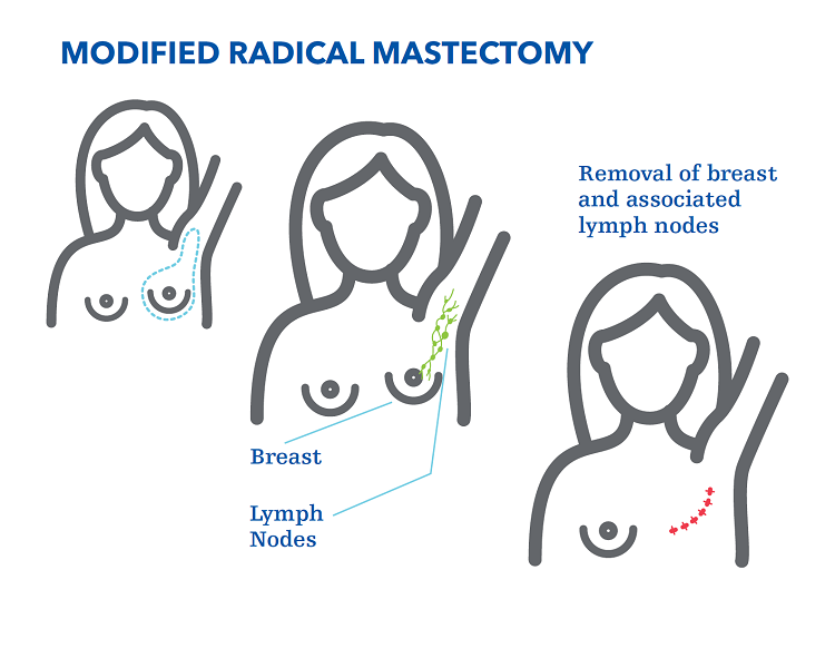 Modified Radical Mastectomy