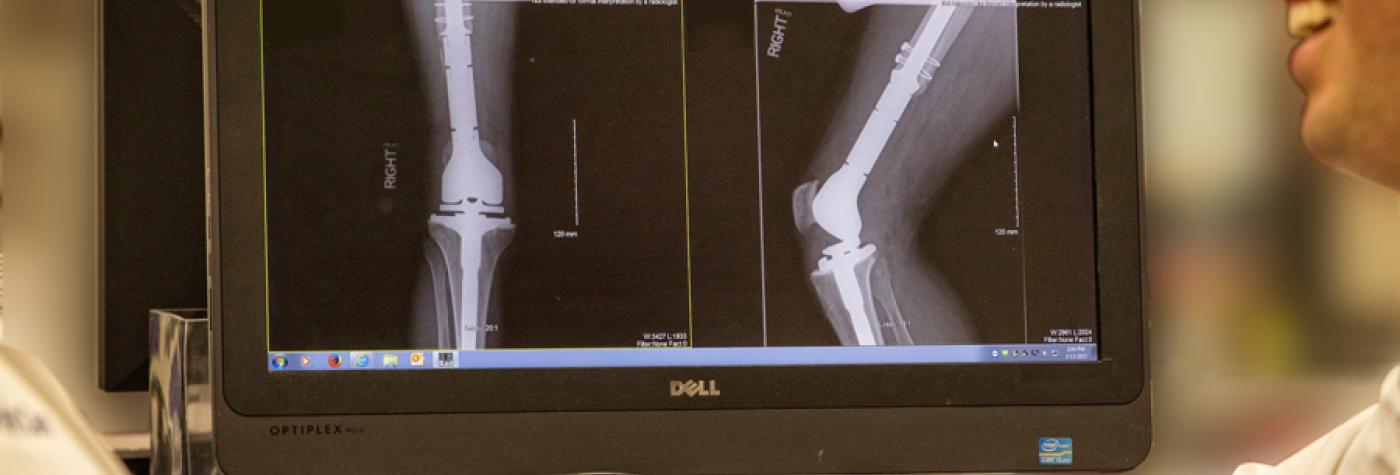 bone cancer diagnosis