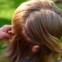 A close-up of Sarah Beth’s hair reveals her scar from her surgery, which wraps around one side of her head.