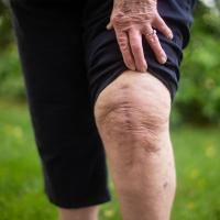 A close-up photo of the scar on Helen’s knee.