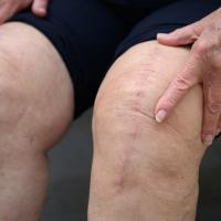 A close-up photo of Helen’s hand resting on top of her knee with her scar visible.