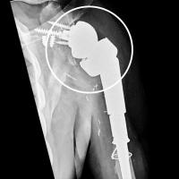 An x-ray of Leonard's new shoulder.